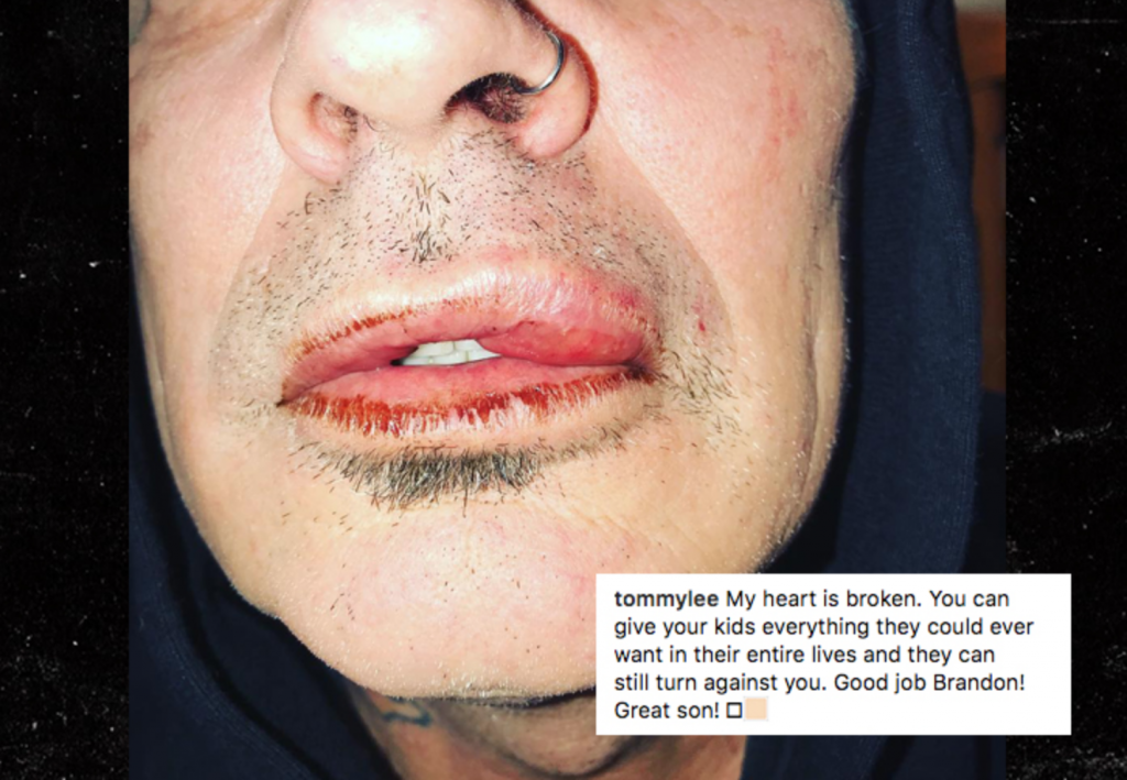 Tommy Lee says he was assaulted by his son